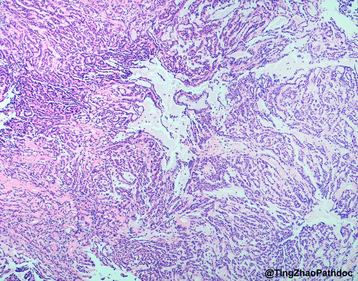 TingZhaoPathdoc's tweet photo. A 3.2 cm renal mass was incidentally discovered during the evaluation for bilateral kidney and liver donation. What is your diagnosis?

#PathTwitter
@RepettoF_MD @MGBpathology @MGHPathology https://t.co/vcddmRzzQm