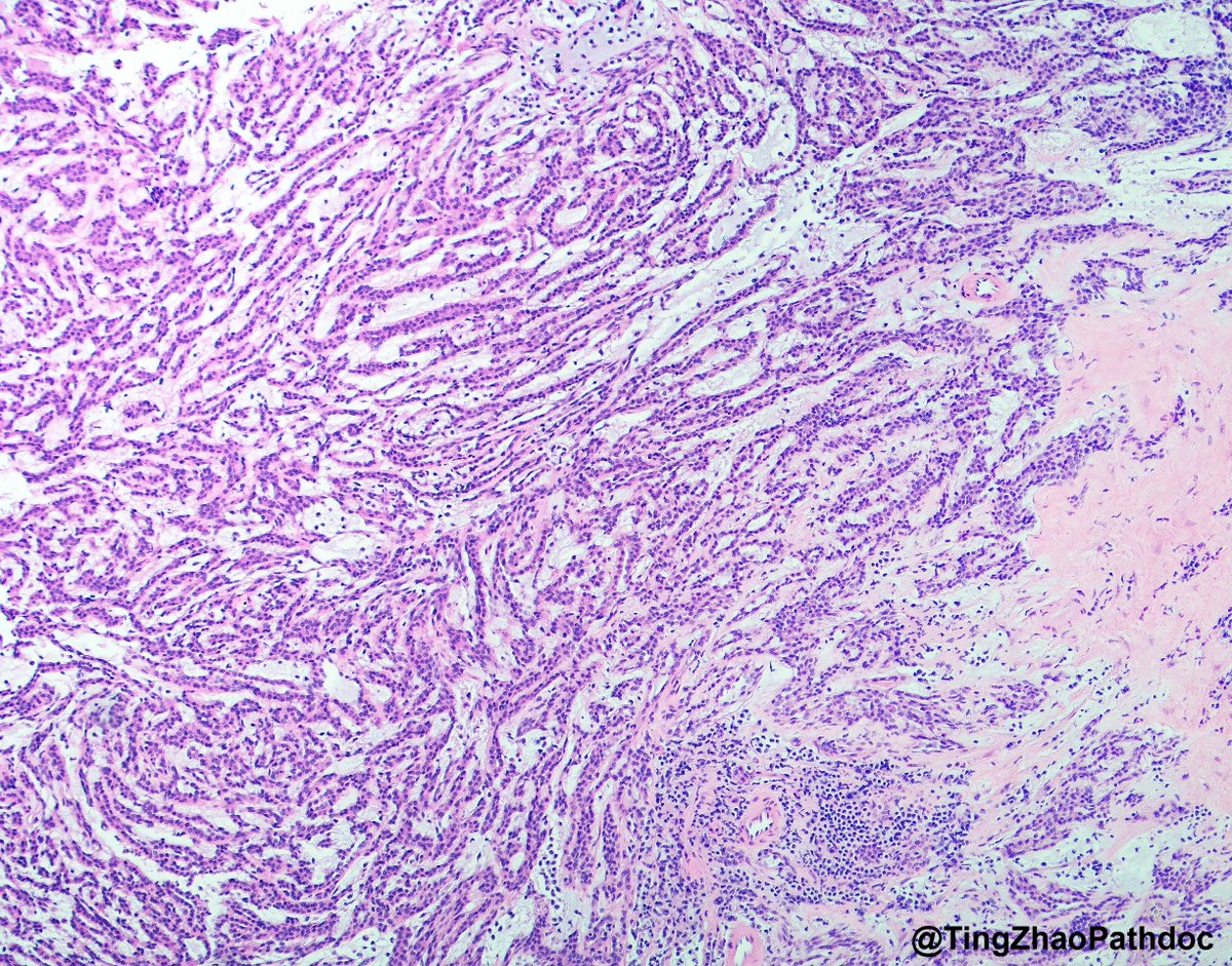 TingZhaoPathdoc's tweet photo. A 3.2 cm renal mass was incidentally discovered during the evaluation for bilateral kidney and liver donation. What is your diagnosis?

#PathTwitter
@RepettoF_MD @MGBpathology @MGHPathology https://t.co/vcddmRzzQm