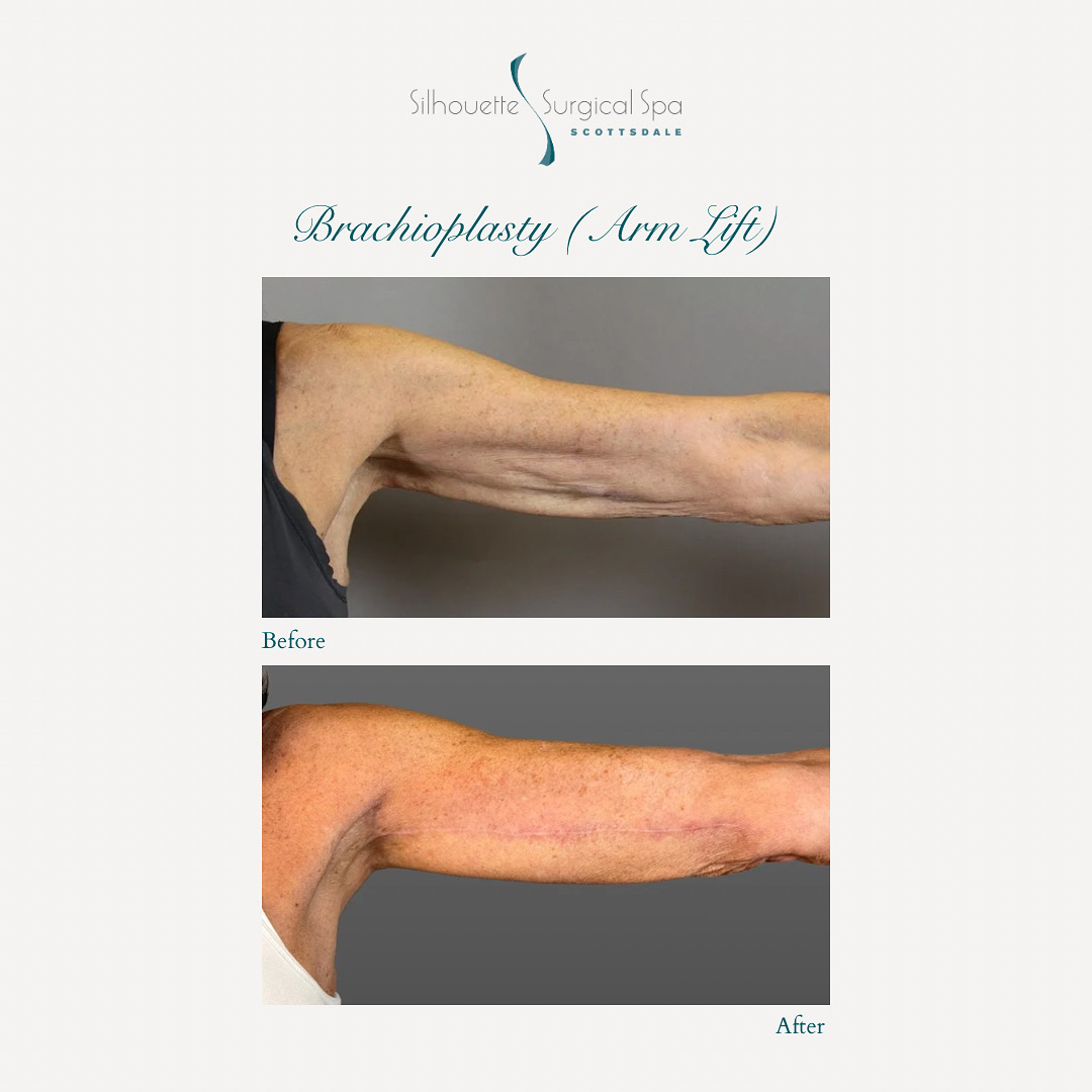 surgicalspa's tweet photo. ✨ Before &amp; After: Brachioplasty ✨
Remove excess skin + contour your arms for a smoother, firmer look.
📆 Now booking consultations!
📍 Scottsdale, AZ
🔗 https://t.co/55RQKyTu7Q

#Brachioplasty #ArmLift #ScottsdaleSurgery #BodyContour #DrPtak #plasticsurgery https://t.co/pSxeFNN2cv