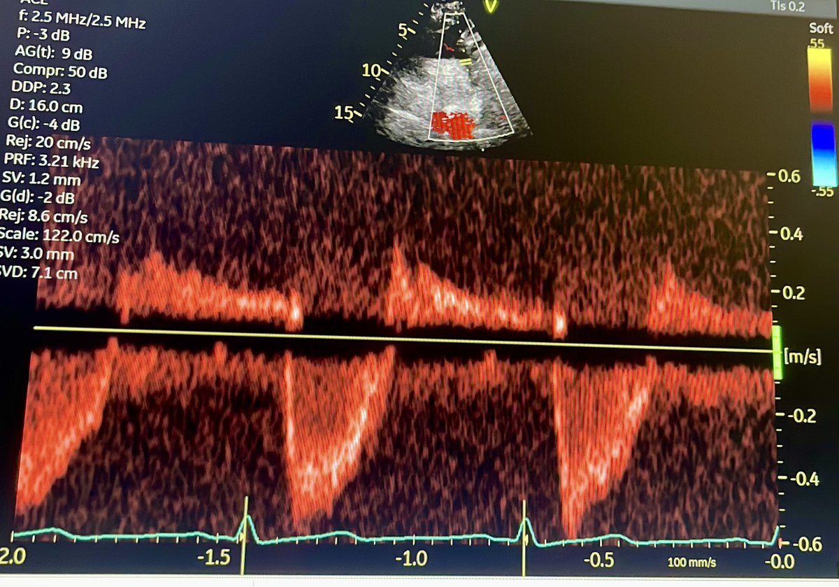 Echo for fellows (@bhaskararora_md) on Twitter photo What inference can be made with this SSN image showing PWD of descending thoracic aorta?
1. Severe AR
2. Moderate AR
3. Mild AR
4. No AR
5. Insufficient data
<a href="/ASE360/">American Society of Echocardiography</a> <a href="/OHSUCardFellows/">OHSU Cardiology Fellowship</a> <a href="/iamritu/">Ritu Thamman MD</a> #ACCFIT What inference can be made with this SSN image showing PWD of descending thoracic aorta?
1. Severe AR
2. Moderate AR
3. Mild AR
4. No AR
5. Insufficient data
<a href="/ASE360/">American Society of Echocardiography</a> <a href="/OHSUCardFellows/">OHSU Cardiology Fellowship</a> <a href="/iamritu/">Ritu Thamman MD</a> #ACCFIT