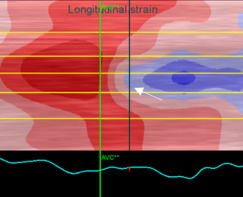 ASA (@asasonography) on Twitter photo đ Two cases published in Sonography describe where the phenomenon of ASERP (Asynchronous segmental early relaxation phenomenon) with exercise is highlighted and the role of 2D speckle-tracking echo and myocardial work in its assessment. <a href="/WileyHealth/">Wiley Clinical Health</a>
loom.ly/jP0mAY8 đ Two cases published in Sonography describe where the phenomenon of ASERP (Asynchronous segmental early relaxation phenomenon) with exercise is highlighted and the role of 2D speckle-tracking echo and myocardial work in its assessment. <a href="/WileyHealth/">Wiley Clinical Health</a>
loom.ly/jP0mAY8