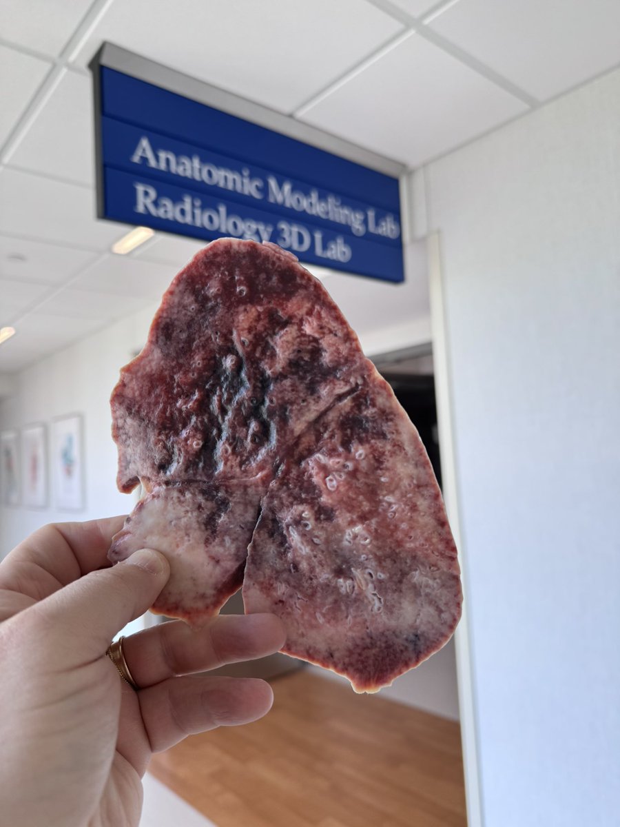 Jay Morris (@jaymorris_md) on Twitter photo When you want to hold lung tissue in your hands why not #3Dprint it . Working with <a href="/joemaleszewski/">Joe Maleszewski, MD</a> <a href="/MayoClinicPath/">Mayo Clinic Pathology</a> and <a href="/MayoRadiology/">Mayo Clinic Radiology</a> we use #photogrammetry to capture and then photorealistic printing. #3D #MedEd #anatomy #lung #breath #mayoclinic #Pathology #radiology When you want to hold lung tissue in your hands why not #3Dprint it . Working with <a href="/joemaleszewski/">Joe Maleszewski, MD</a> <a href="/MayoClinicPath/">Mayo Clinic Pathology</a> and <a href="/MayoRadiology/">Mayo Clinic Radiology</a> we use #photogrammetry to capture and then photorealistic printing. #3D #MedEd #anatomy #lung #breath #mayoclinic #Pathology #radiology