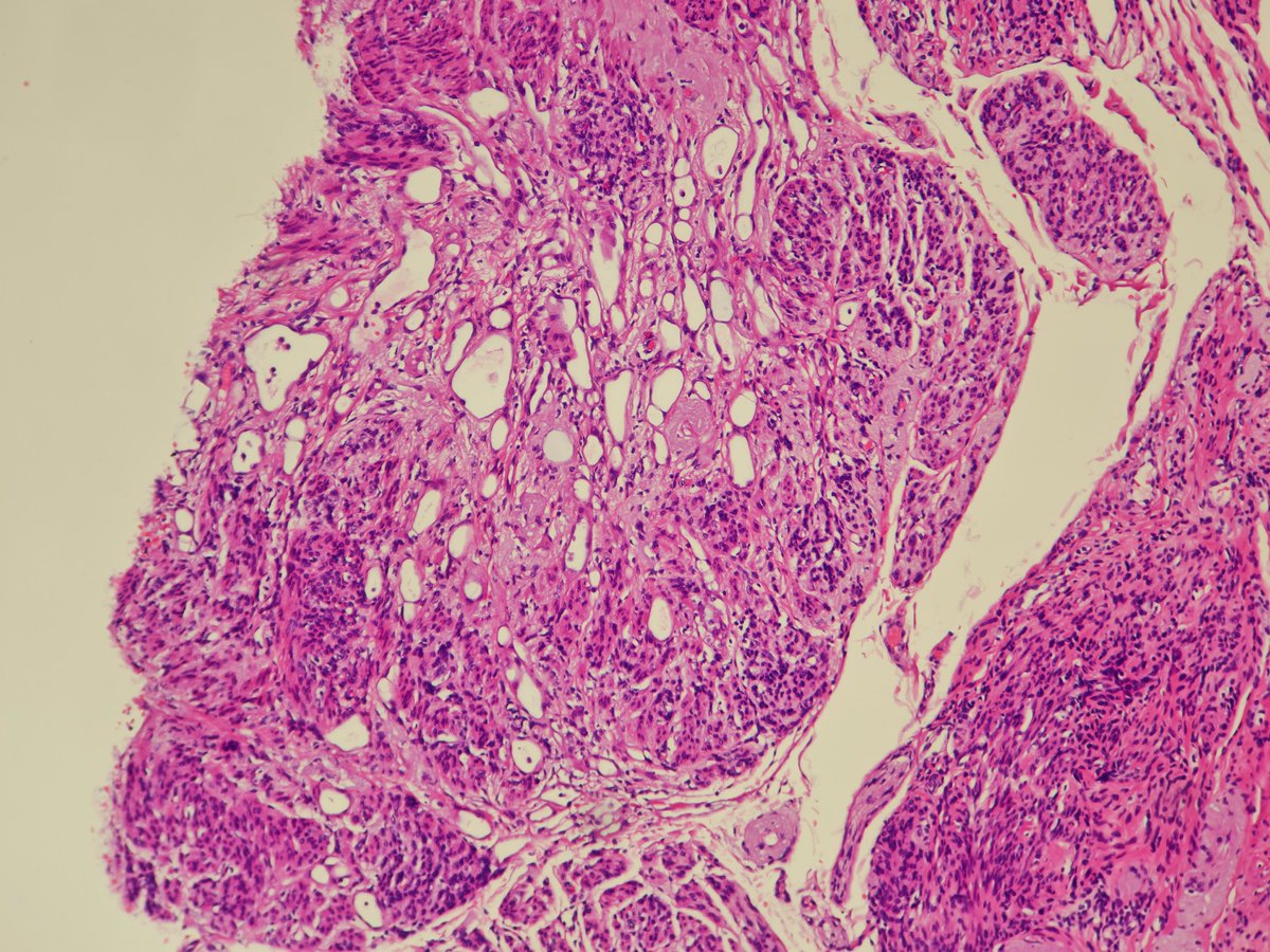 MirunaPopescu13's tweet image. Incidental finding in the uterine corpus.

What's the stain? What's the diagnosis?
#gynpath #beautyinb9 #pathtwitter