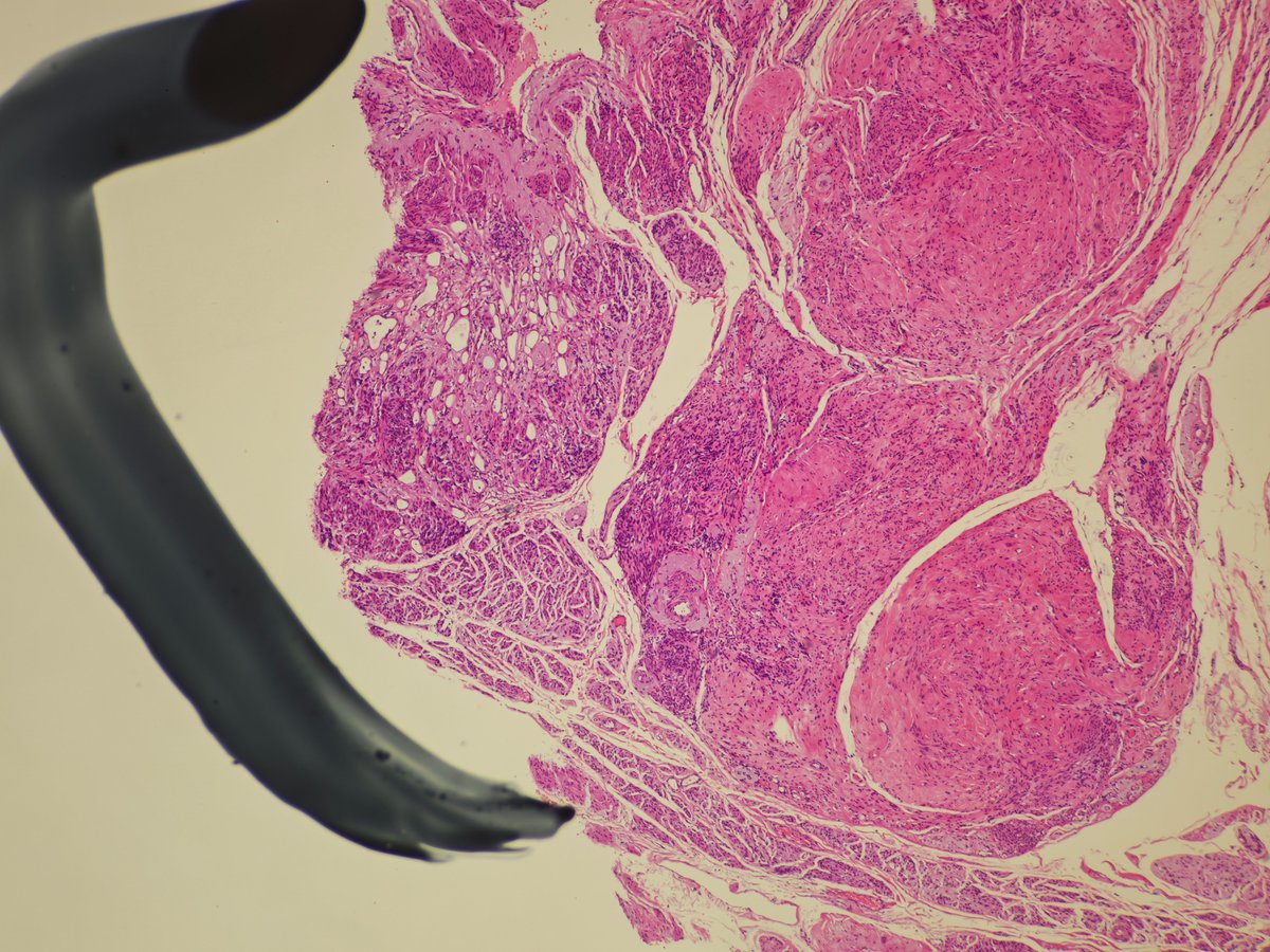 MirunaPopescu13's tweet image. Incidental finding in the uterine corpus.

What's the stain? What's the diagnosis?
#gynpath #beautyinb9 #pathtwitter