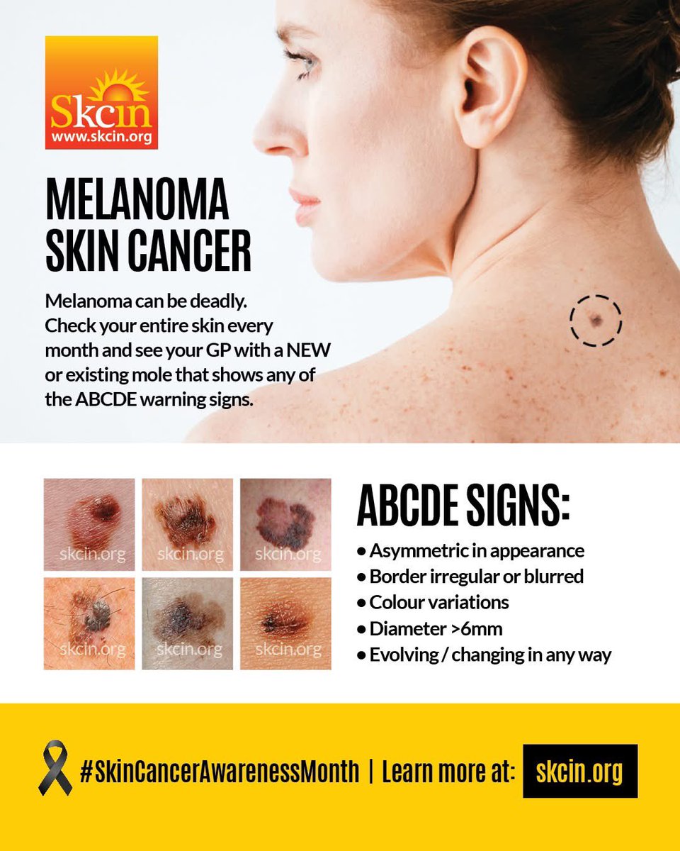 ‼ Around 70% of melanoma follow the ABCDE warning signs... but be warned:

Whilst the ABCDE signs provide a great detection tool - the vast majority of melanoma actually arise as a new mole! This means they can be very small (often dark / almost black in appearance) and can be