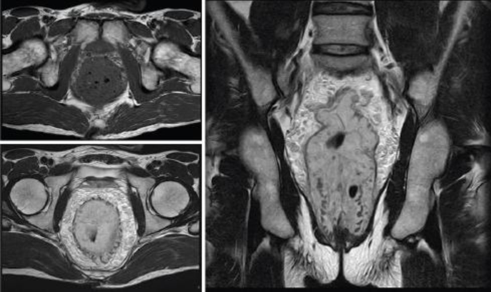 Shingo_Omata's tweet photo. <What’s your diagnosis?>
👤 34M with long-standing painless rectal bleeding
🩸 Severe anemia requiring transfusion
#Rdiag #MedEd #RadEd #GIrad #Colorectal #FOAMrad #FOAMed https://t.co/iJCGJeu9DX