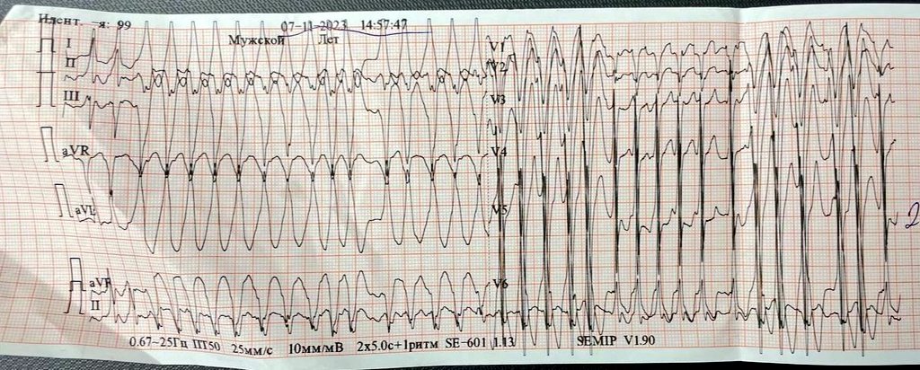 A 13 y.o patient with palpitation, dx?