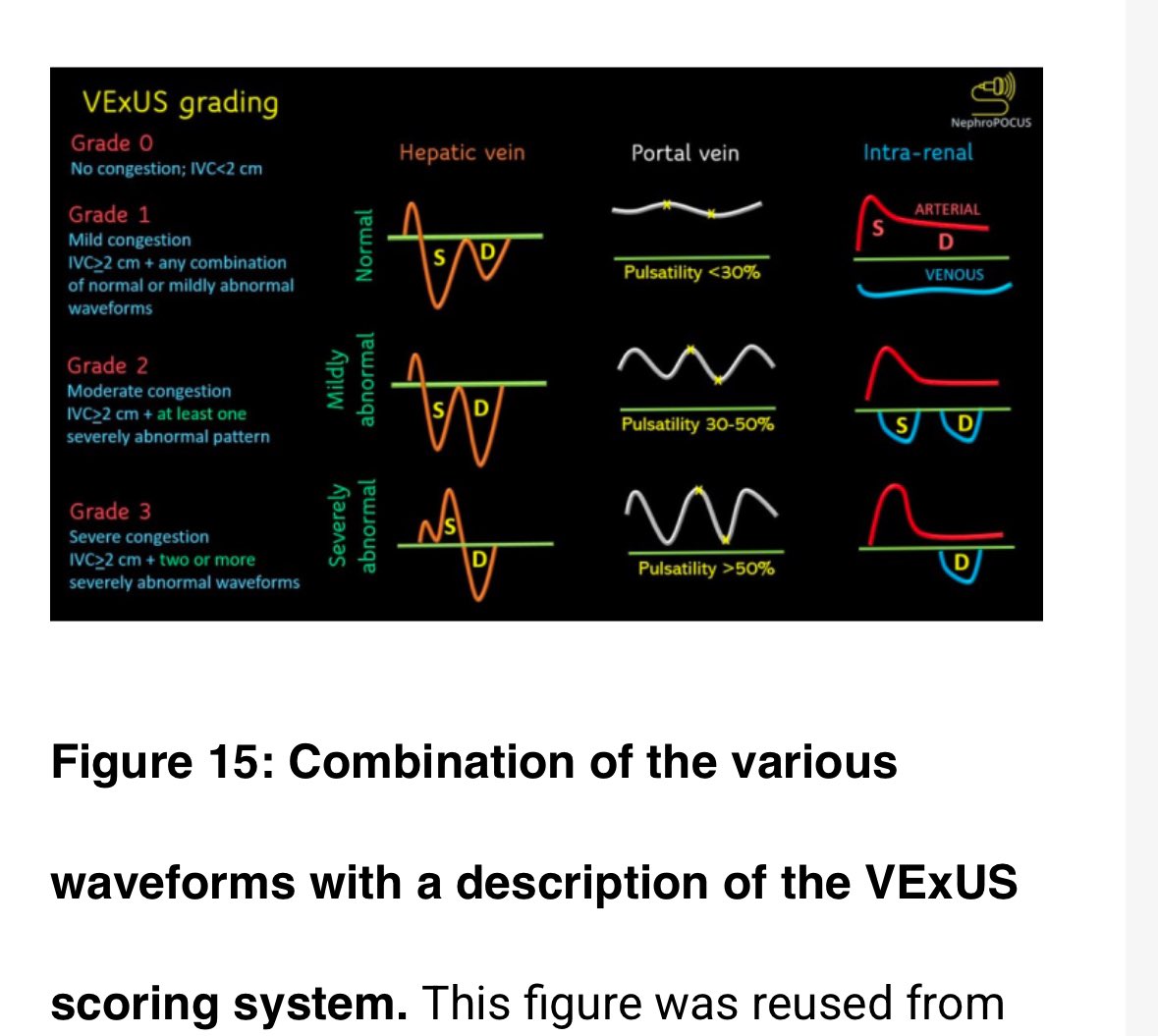 🩺 Hari (హరి 🇮🇳) Kalagara (@kalagarahari) on Twitter photo #POCUS
💥Check out …. 💦Demystifying #VExUS 💦 !
👉 review.jove.com/t/68107/demyst… <a href="/NephroP/">NephroPOCUS</a> <a href="/thefyuriy/">Yuriy Bronshteyn 🇺🇦</a> <a href="/DukeU/">Duke University</a> 🙏 <a href="/ASRA_Society/">ASRA Pain Medicine</a> <a href="/POCUSIAPN/">IAPN</a> <a href="/ArgaizR/">Eduardo R Argaiz</a> <a href="/pandompatam/">Govind Panda</a> <a href="/nathanhwaldron/">Nathan Waldron</a> <a href="/pmgjones/">Philip Jones</a> <a href="/msenussiMD/">Mourad H Senussi, MD, MS</a> <a href="/SCCM/">SCCM</a> <a href="/scahq/">Society of Cardiovascular Anesthesiologists | SCA</a> <a href="/ArcherKMartin/">Archer Martin</a> <a href="/pkguru10/">Pramod K Guru.MBBS,MD,DM,FASN</a> <a href="/curromir/">Curro Miralles</a> <a href="/casualtysrus/">Chris Yap</a> <a href="/shaskinsMD/">Stephen Haskins</a> #POCUS
💥Check out …. 💦Demystifying #VExUS 💦 !
👉 review.jove.com/t/68107/demyst… <a href="/NephroP/">NephroPOCUS</a> <a href="/thefyuriy/">Yuriy Bronshteyn 🇺🇦</a> <a href="/DukeU/">Duke University</a> 🙏 <a href="/ASRA_Society/">ASRA Pain Medicine</a> <a href="/POCUSIAPN/">IAPN</a> <a href="/ArgaizR/">Eduardo R Argaiz</a> <a href="/pandompatam/">Govind Panda</a> <a href="/nathanhwaldron/">Nathan Waldron</a> <a href="/pmgjones/">Philip Jones</a> <a href="/msenussiMD/">Mourad H Senussi, MD, MS</a> <a href="/SCCM/">SCCM</a> <a href="/scahq/">Society of Cardiovascular Anesthesiologists | SCA</a> <a href="/ArcherKMartin/">Archer Martin</a> <a href="/pkguru10/">Pramod K Guru.MBBS,MD,DM,FASN</a> <a href="/curromir/">Curro Miralles</a> <a href="/casualtysrus/">Chris Yap</a> <a href="/shaskinsMD/">Stephen Haskins</a>
