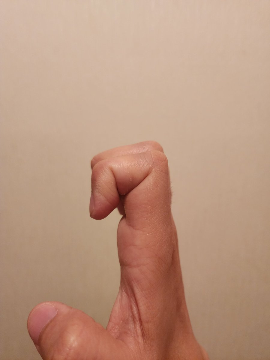 mikewazowskiMM's tweet image. 腫れと痛みがなくなりました！
ただ、握ろうとすると神経？に違和感があってイヤーな感じ。

やっぱりニンラーロの副作用っぽい。
薬変えたいけど、新しい薬何があるんやろ