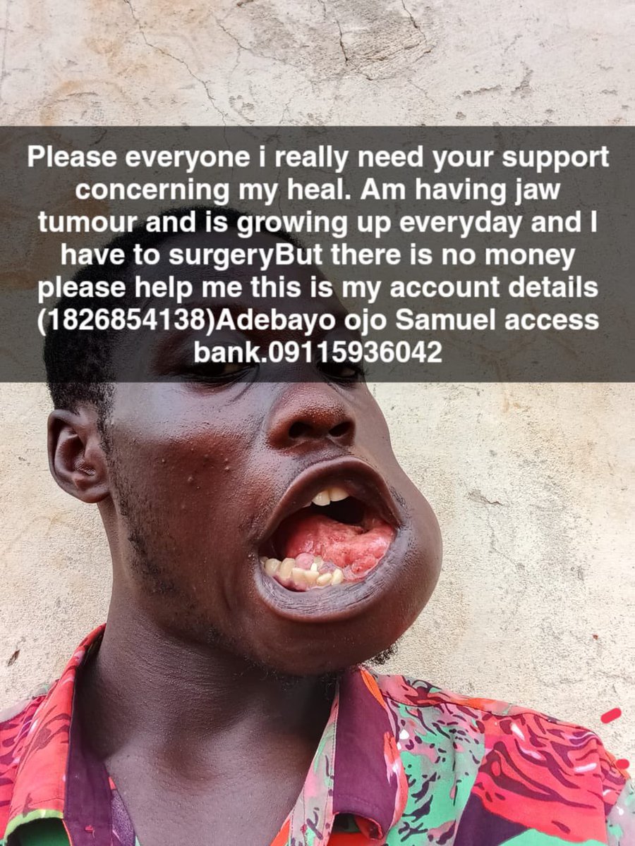 Ammmeenah's tweet photo. This is a before and after picture of Samuel.
He had to move from Lagos state to his village in Owo, Akure state. Please Samuel needs our help to undergo surgery for the tumor in his jaw.
Please donate and rt
1826854138 Access bank[Adebayo Ojo Samuel] https://t.co/9CIK4Vys6S