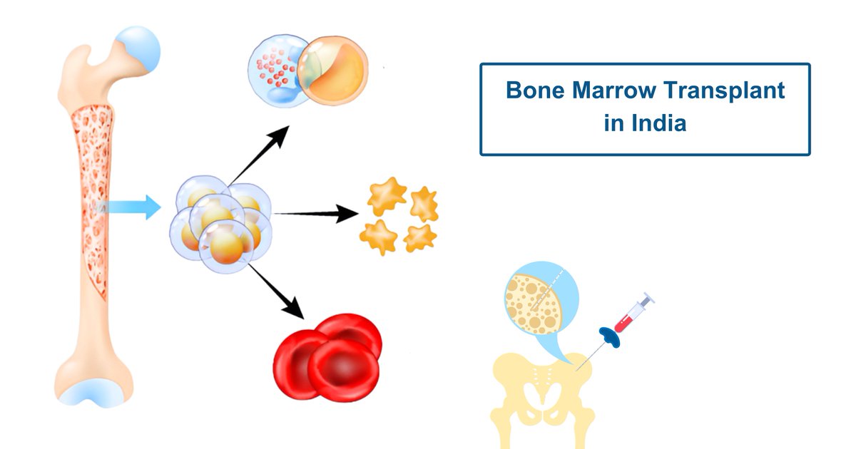 HealthGateindia's tweet photo. bone marrow transplant can be a life-saving treatment for leukemia, lymphoma, and more. Restore healthy blood cell production and start your healing journey.

#BoneMarrowTransplant #BMT #CancerCare #stemcelltherapy https://t.co/YV57CbTrtZ