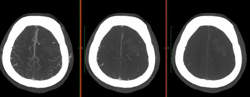 UPensato's tweet photo. Do these spot signs in hemorrhagic #stroke look equal to you? Perhaps in the arterial phase, yet their evolution across phases in #mCTA can tell you much more. Please contact us if your center performs mCTA in ICH and is interested in collaboration. AndrewDemchuk @rondalun1 https://t.co/XyiHVuZ76R