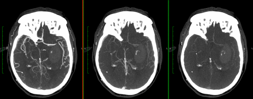UPensato's tweet photo. Do these spot signs in hemorrhagic #stroke look equal to you? Perhaps in the arterial phase, yet their evolution across phases in #mCTA can tell you much more. Please contact us if your center performs mCTA in ICH and is interested in collaboration. AndrewDemchuk @rondalun1 https://t.co/XyiHVuZ76R