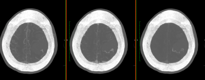 UPensato's tweet photo. Do these spot signs in hemorrhagic #stroke look equal to you? Perhaps in the arterial phase, yet their evolution across phases in #mCTA can tell you much more. Please contact us if your center performs mCTA in ICH and is interested in collaboration. AndrewDemchuk @rondalun1 https://t.co/XyiHVuZ76R