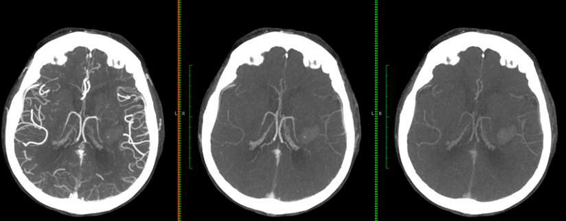 UPensato's tweet photo. Do these spot signs in hemorrhagic #stroke look equal to you? Perhaps in the arterial phase, yet their evolution across phases in #mCTA can tell you much more. Please contact us if your center performs mCTA in ICH and is interested in collaboration. AndrewDemchuk @rondalun1 https://t.co/XyiHVuZ76R