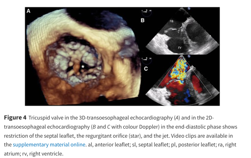 European Society of Cardiology Journals (@esc_journals) on Twitter photo A not so straightforward case of atrial fibrillation and flutter - what was the role of the tricuspid valve? doi.org/10.1093/ehjcr/…
#EHJCaseReports <a href="/Phiso_de/">Philipp Sommer</a> <a href="/TJ_Yeo/">Tee Joo YEO</a> <a href="/aayshacader/">Aaysha Cader</a> <a href="/BoldiKovacsMD/">Boldizsar Kovacs</a> <a href="/KardiologieHH/">Erik Rafflenbeul</a> <a href="/ANazmiCalik/">A.Nazmi Calik</a> <a href="/O_Azizy_MD/">Obayda Azizy</a> <a href="/saramoscatelli7/">Sara Moscatelli</a> <a href="/EHJCREiC/">EHJCaseReports Editor-in-Chief</a> #CardioX #EPeeps A not so straightforward case of atrial fibrillation and flutter - what was the role of the tricuspid valve? doi.org/10.1093/ehjcr/…
#EHJCaseReports <a href="/Phiso_de/">Philipp Sommer</a> <a href="/TJ_Yeo/">Tee Joo YEO</a> <a href="/aayshacader/">Aaysha Cader</a> <a href="/BoldiKovacsMD/">Boldizsar Kovacs</a> <a href="/KardiologieHH/">Erik Rafflenbeul</a> <a href="/ANazmiCalik/">A.Nazmi Calik</a> <a href="/O_Azizy_MD/">Obayda Azizy</a> <a href="/saramoscatelli7/">Sara Moscatelli</a> <a href="/EHJCREiC/">EHJCaseReports Editor-in-Chief</a> #CardioX #EPeeps