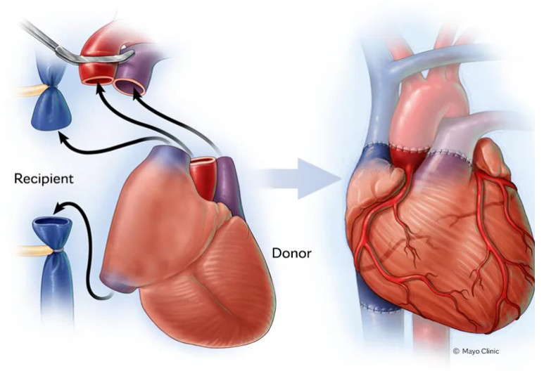 Mayo Clinic Transplant (@mayotransplant) on Twitter photo The International Society for Heart and Lung Transplantation (ISHLT) recommends transitioning patients to mammalian targets of rapamycin inhibitors, such as sirolimus. #Immunosuppression #HeartTransplant <a href="/werDrD/">Andrew (Drew) Rosenbaum, M.D.</a>
mayocl.in/3S9sY0Y The International Society for Heart and Lung Transplantation (ISHLT) recommends transitioning patients to mammalian targets of rapamycin inhibitors, such as sirolimus. #Immunosuppression #HeartTransplant <a href="/werDrD/">Andrew (Drew) Rosenbaum, M.D.</a>
mayocl.in/3S9sY0Y