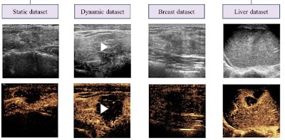Radiology: Artificial Intelligence (@radiology_ai) on Twitter photo Evaluating pseudo-contrast-enhanced #ultrasound for tumor ablation using a GAN doi.org/10.1148/ryai.2… <a href="/CAS__Science/">Chinese Academy of Sciences</a> <a href="/Tongji_Uni/">Tongji University</a> #AI #ML #MachineLearning Evaluating pseudo-contrast-enhanced #ultrasound for tumor ablation using a GAN doi.org/10.1148/ryai.2… <a href="/CAS__Science/">Chinese Academy of Sciences</a> <a href="/Tongji_Uni/">Tongji University</a> #AI #ML #MachineLearning