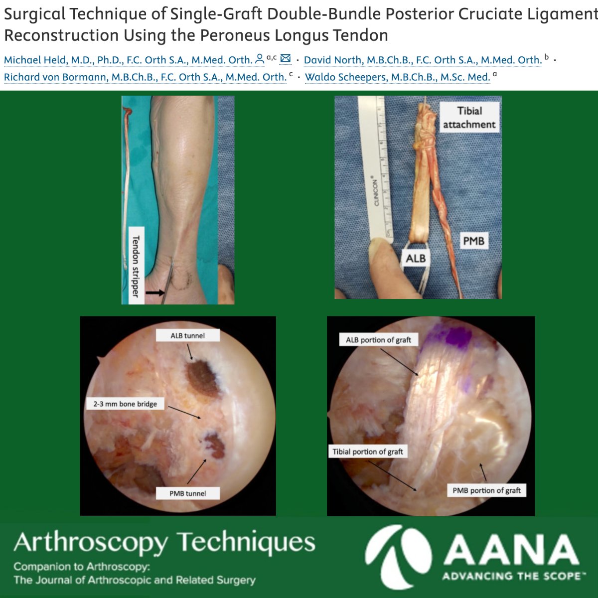 Arthroscopy Journal (@arthroscopyj) on Twitter photo Check out this technique article for double bundle PCL reconstruction using peroneus longus autograft recently published in ATech.
ow.ly/hVGz50VUpOO
#orthoX #sportsmedicine #PCL #knee <a href="/UCT_ORU/">Orthopaedic Research Unit</a> Check out this technique article for double bundle PCL reconstruction using peroneus longus autograft recently published in ATech.
ow.ly/hVGz50VUpOO
#orthoX #sportsmedicine #PCL #knee <a href="/UCT_ORU/">Orthopaedic Research Unit</a>