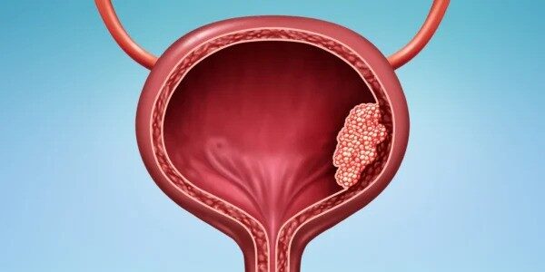 OncoDaily (@oncodaily) on Twitter photo Tres Uramigas - Major Changes in the Treatment of Urothelial Cancer
<a href="/TresUramigas/">Tres Uramigas</a>
oncodaily.com/blog/urothelia…
#Cancer #CancerTreatment #CancerResearch #UrothelialCancer #Immunotherapy #Medicine #Health #MedX #MedNews #MedEd #Oncology #OncoDaily Tres Uramigas - Major Changes in the Treatment of Urothelial Cancer
<a href="/TresUramigas/">Tres Uramigas</a>
oncodaily.com/blog/urothelia…
#Cancer #CancerTreatment #CancerResearch #UrothelialCancer #Immunotherapy #Medicine #Health #MedX #MedNews #MedEd #Oncology #OncoDaily