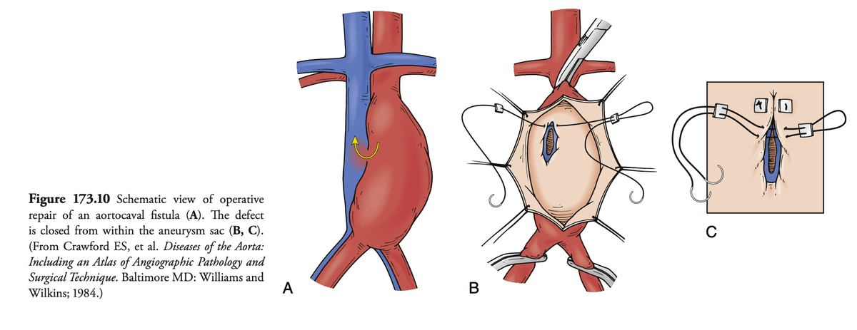 ClampandFlow's tweet photo. 📸 From Rutherford: Pledgeted sutures for robust closure of the fistula.
The aortic &amp; IVC walls are often fused: take both in transaortic bites.

🧭 If feasible:
#EndoFirst → EVAR ± covered IVC stent (fearing IVC thrombus).
📍Monitor closely for endoleaks.

#VascSurg #MedEd #AAA https://t.co/KvWWAA6AQo