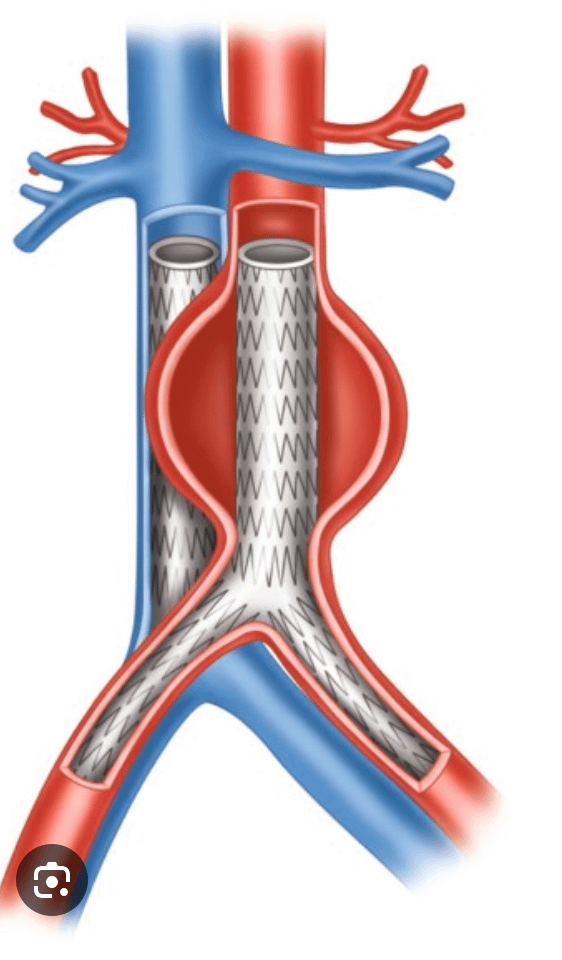 ClampandFlow's tweet photo. 📸 From Rutherford: Pledgeted sutures for robust closure of the fistula.
The aortic &amp; IVC walls are often fused: take both in transaortic bites.

🧭 If feasible:
#EndoFirst → EVAR ± covered IVC stent (fearing IVC thrombus).
📍Monitor closely for endoleaks.

#VascSurg #MedEd #AAA https://t.co/KvWWAA6AQo