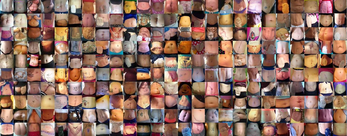 #GetYourBellyOut (@getyourbellyout) on Twitter photo β οΈ We want you to share a #GetYourBellyOut photo on Monday for #WorldIBDday β οΈ
Since 2014, we have been encouraging people to share photos of their bellies on social media to help put a visual aid to what's often considered an invisible illness, and to kick-start a conversation β οΈ We want you to share a #GetYourBellyOut photo on Monday for #WorldIBDday β οΈ
Since 2014, we have been encouraging people to share photos of their bellies on social media to help put a visual aid to what's often considered an invisible illness, and to kick-start a conversation