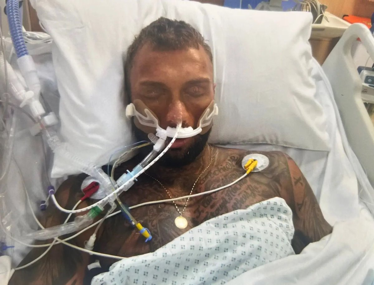 🇬🇧 | Zak Wilkinson, fisicoculturista británico de 32 años, lo dio todo por el cuerpo perfecto: entrenamientos extremos, una dieta obsesiva y más de $46,000 gastados en esteroides. 

Un día, su cuerpo colapsó. Sufrió convulsiones, fue inducido a coma y pasó siete días entre la