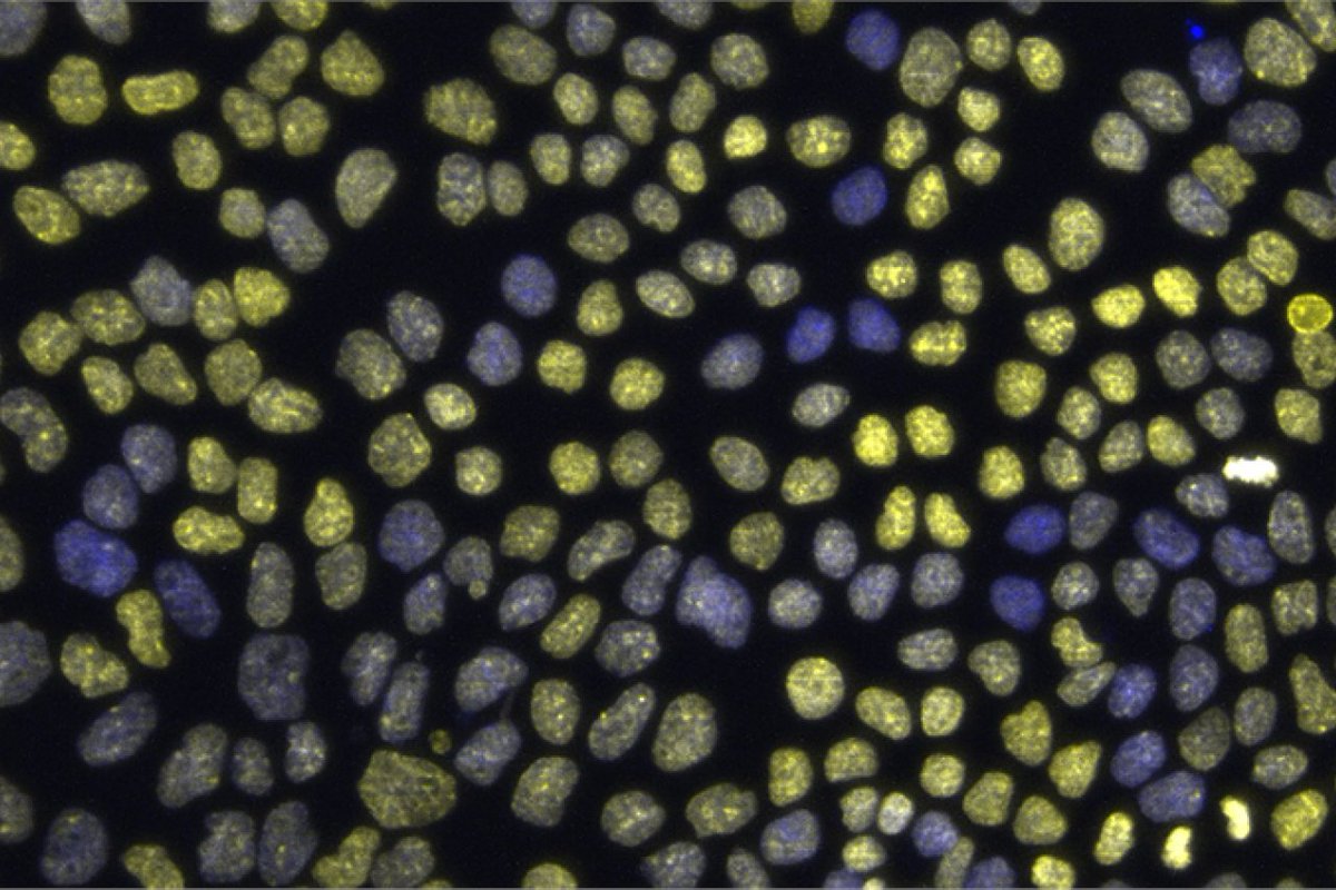 UCLA Health (@uclahealth) on Twitter photo A new study published in <a href="/CommsBio/">Communications Biology</a> could have major implications for cancer research.🔬 Co-principal investigator Neil Lin, PhD, a <a href="/UCLAengineering/">UCLA Samueli Engineering</a> prof. & @uclastemcell member, says the research shows larger nuclei correlate with increased gene activity: ucla.in/4350v2A A new study published in <a href="/CommsBio/">Communications Biology</a> could have major implications for cancer research.🔬 Co-principal investigator Neil Lin, PhD, a <a href="/UCLAengineering/">UCLA Samueli Engineering</a> prof. & @uclastemcell member, says the research shows larger nuclei correlate with increased gene activity: ucla.in/4350v2A