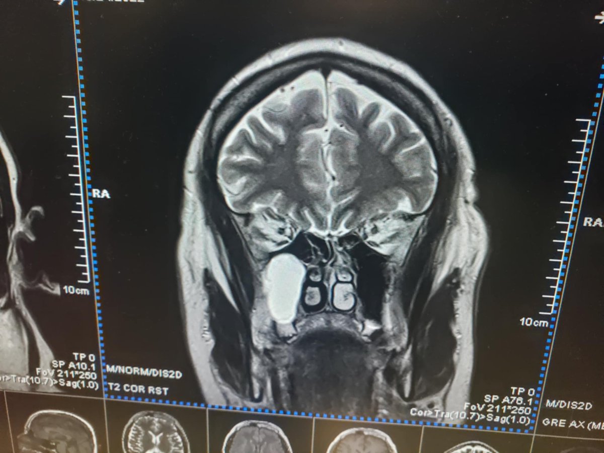 I know I shouldn't use <a href="/X/">X</a> for this, but does anyone into #nuerology or #psychiatry want to chime in on #whitematterdisease and #treatmentresistantdepression/#trd? Here's an #mri of my #brain, circa 2022. Right sinus cavity is a cyst.