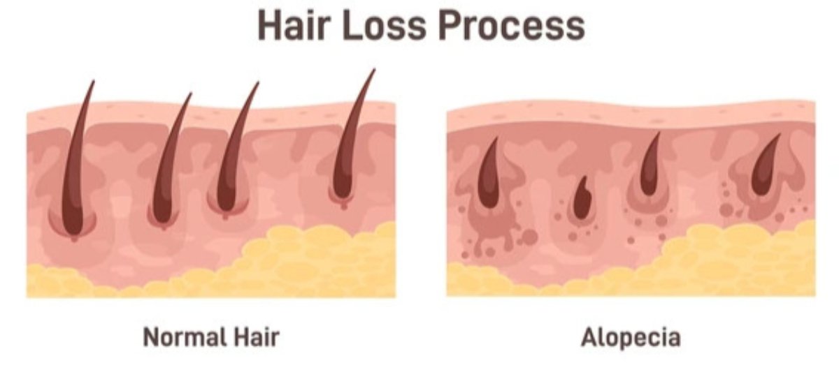 Todas las personas mayores de 35 años culpan al envejecimiento de tener menos cabello.

Resulta que no es la edad.

Son las hormonas, el flujo sanguíneo y años de descuido.

Aquí tienes 3 soluciones sencillas para prevenir la caída del cabello y revertirla de forma natural: