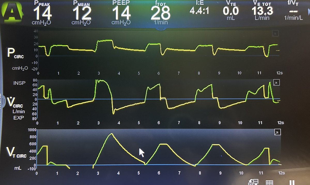 Mohammed Megri. MD (@megrimohammed) on Twitter photo What is the TAG, inspiratory load, and expiratory load? What are your thoughts about the patient–machine interaction? What can you do to help the patient?
<a href="/ArielG_RRT/">Ariel J Garnero</a> <a href="/emireles_c/">Eduardo Mireles-Cabodevila</a> <a href="/_MSAMEED/">Sameed M</a> <a href="/Vent_Busters/">VentBusters</a> <a href="/ThinkingCC/">Philippe Rola</a> <a href="/msiuba/">Matt Siuba</a> <a href="/IM_Crit_/">IMCrit</a> <a href="/critconcepts/">Critical Concepts</a> <a href="/PulmPEEPs/">Pulm PEEPs</a> <a href="/accpchest/">CHEST</a> What is the TAG, inspiratory load, and expiratory load? What are your thoughts about the patient–machine interaction? What can you do to help the patient?
<a href="/ArielG_RRT/">Ariel J Garnero</a> <a href="/emireles_c/">Eduardo Mireles-Cabodevila</a> <a href="/_MSAMEED/">Sameed M</a> <a href="/Vent_Busters/">VentBusters</a> <a href="/ThinkingCC/">Philippe Rola</a> <a href="/msiuba/">Matt Siuba</a> <a href="/IM_Crit_/">IMCrit</a> <a href="/critconcepts/">Critical Concepts</a> <a href="/PulmPEEPs/">Pulm PEEPs</a> <a href="/accpchest/">CHEST</a>