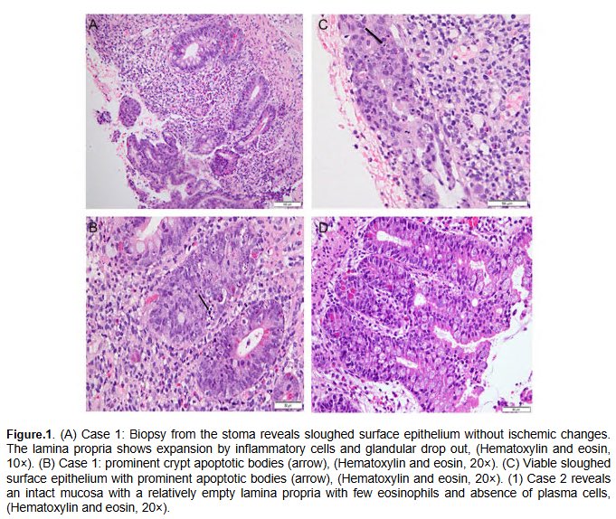 PediDevPath (@pedidevpath) on Twitter photo 🚨 New Podcast Episode!
We speak with Dr. Saeeda Almarzooqi of United Arab Emirates University about her article in <a href="/PediDevPath/">PediDevPath</a>: Hereditary Multiple Intestinal Atresia With a Novel TTC7A Pathogenic Variant
#PediPath
Listen now on your favorite app!
pedidevpath.podbean.com/e/hereditary-m… 🚨 New Podcast Episode!
We speak with Dr. Saeeda Almarzooqi of United Arab Emirates University about her article in <a href="/PediDevPath/">PediDevPath</a>: Hereditary Multiple Intestinal Atresia With a Novel TTC7A Pathogenic Variant
#PediPath
Listen now on your favorite app!
pedidevpath.podbean.com/e/hereditary-m…