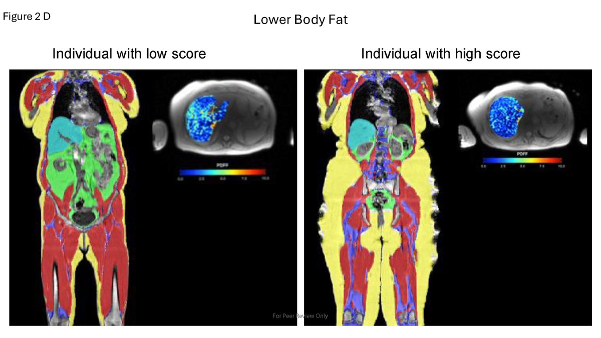 Diabetes, a research journal of the ADA 🧪 (@diabetes_ada) on Twitter photo Identifying four obesity axes through integrative multi-omics and imaging analysis.
Read Here➡️diabetesjournals.org/diabetes/looku…
<a href="/ADA_Pubs/">ADA Professional Publications</a> Identifying four obesity axes through integrative multi-omics and imaging analysis.
Read Here➡️diabetesjournals.org/diabetes/looku…
<a href="/ADA_Pubs/">ADA Professional Publications</a>