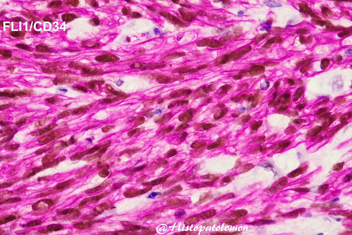 Histopatolomon's tweet photo. Okay, we're clear on the diagnosis and that the red chromogen belongs to CD34. The nuclear chromogen was missing. Which is FLI1. @Margazhi_ta said it. 👏👏👏
#IHC #FLI1 #CD34 #Sarcoma #Kaposi #dermpath #pathology https://t.co/6akWruUvEU