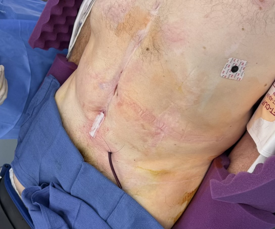 SP RALP after open post chemo RPLND and another after ex-lap after major blunt trauma. Single port enables easy/safer access in hostile abdomens. Hard to imagine going back to multiport for cases like these

<a href="/asajimd/">Akhil A Saji, MD</a> <a href="/MickeyBmickeyB/">Mickey Bindra</a>