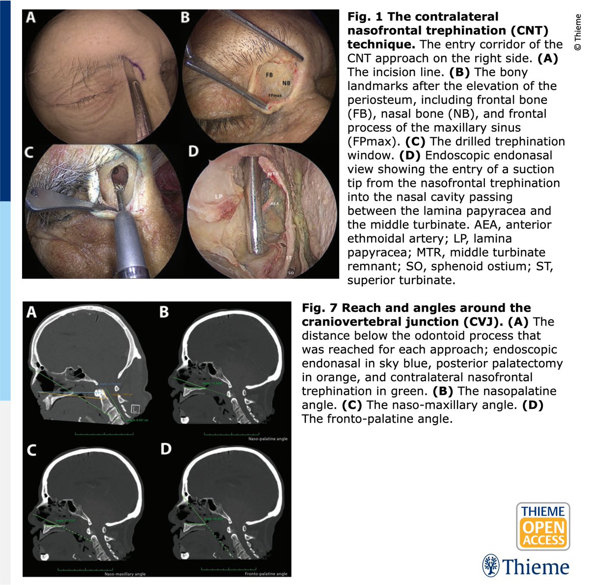 Journal of Neurological Surgery (JNLS) (@jnlsreports) on Twitter photo The #RhotonAward 2025 article is hot off the press —
👃🧠Check out their novel approach to the craniovertebral junction:
thieme-connect.com/products/ejour…
Video: mr316.video-stream-hosting.de/tvg/opn/cs/25/…
Congrats to the authors for their tremendous work 🎉
#JNLSB #skullbase #otolaryngology #neurosurgery The #RhotonAward 2025 article is hot off the press —
👃🧠Check out their novel approach to the craniovertebral junction:
thieme-connect.com/products/ejour…
Video: mr316.video-stream-hosting.de/tvg/opn/cs/25/…
Congrats to the authors for their tremendous work 🎉
#JNLSB #skullbase #otolaryngology #neurosurgery