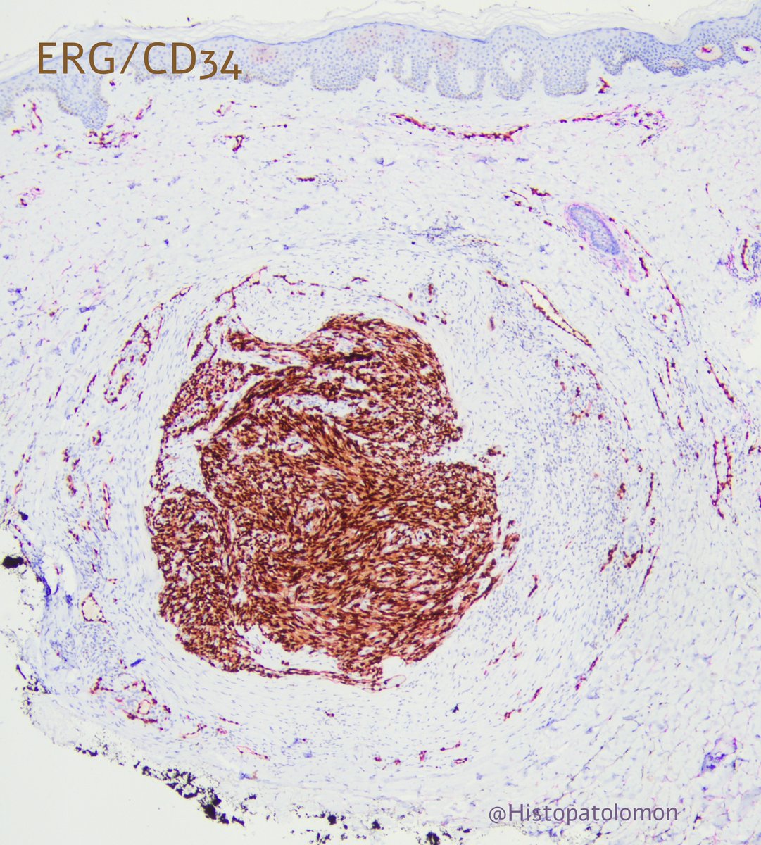 Histopatolomon's tweet photo. For ERG fans, here's an ERG/CD34 stain. As you can see, it's not as pretty as the other one. #IHCpath #ERG #CD34 #Sarcoma #Kaposi #pathology https://t.co/ph9qg3XHDo