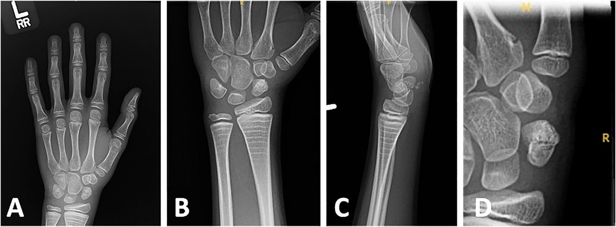 jbjs's tweet photo. "Scaphoid Reconstruction Following Nonunion in Osteogenesis Imperfecta" Lenartowicz et al.

https://t.co/mTnIIRw0lm https://t.co/P4ltYFfAVT