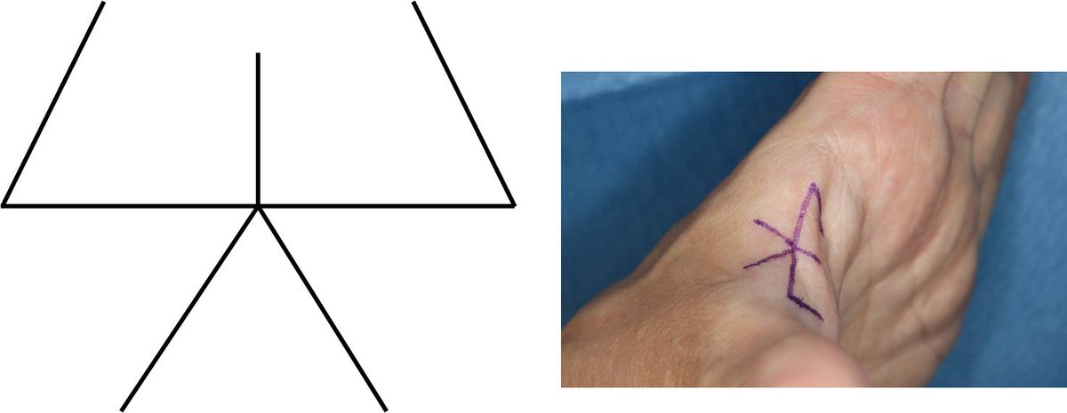 この局所皮弁の意味は？？】 前回Z形成術の続きです。 このような局所