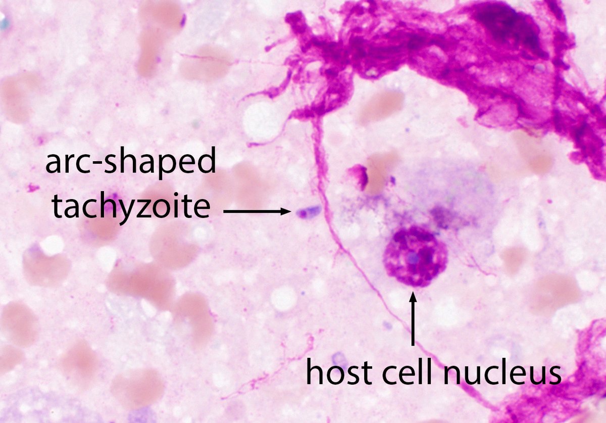 ParasiteGal's tweet photo. The answer to the #Parasite Case 776 is now up: Toxoplasma gondii free and intracellular tachzoites. Read the description of findings here: https://t.co/1e8tV6q49f #pathology #PathBugs https://t.co/wOuLfJCT2s