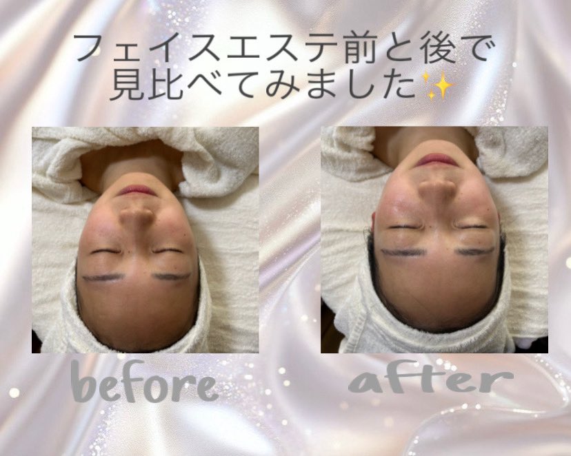 イベントが決まりました〜👏
今しかない限定価格です💓
#フェイスエステ #サロン #肌荒れ #そばかす #ニキビ #シミ #シワ #たるみ #乾燥 #肌荒れ #毛穴 #くすみ #肌トラブル #綺麗になりたい #結婚 #メイク #群馬 #伊勢崎