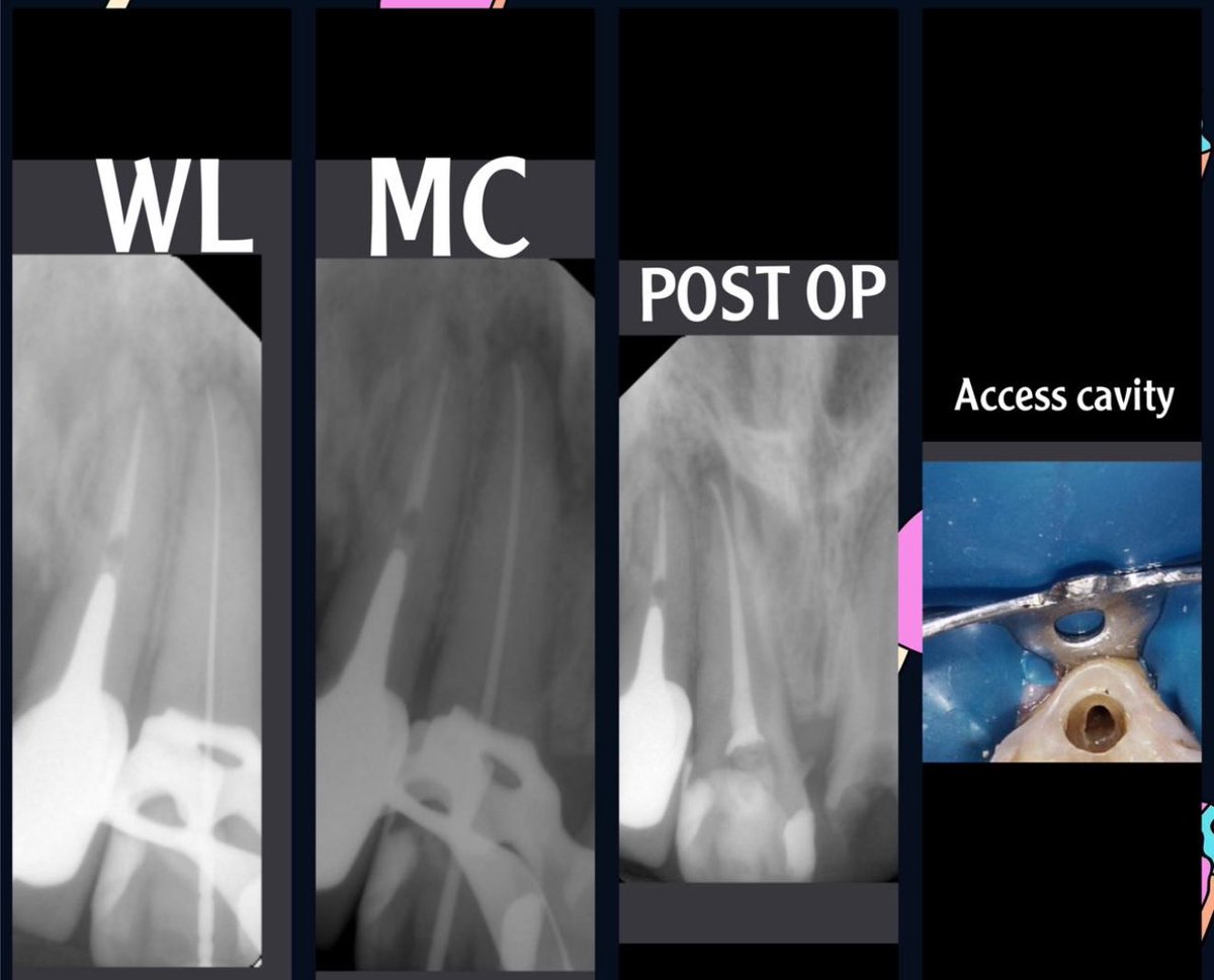 dentkhaled1's tweet photo. #11 Single visit RCT 
-Necrotic 
-SAP https://t.co/fHhnr98ttC