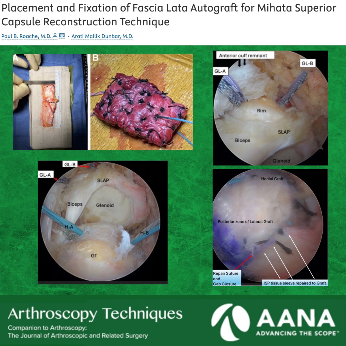 Check out this technique for the Mihata SCR using fascia lata autograft. 

ow.ly/zBJN50VUBZO
#orthoX #sportsmedicine #shoulder
