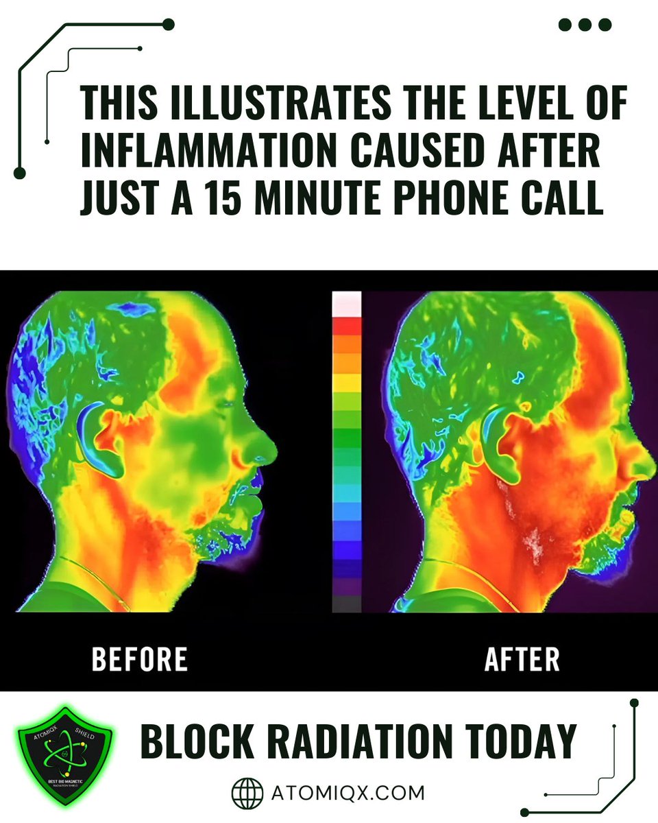 Atomiqx_Tech's tweet photo. 📱🚨 JUST 15 MINUTES ON YOUR PHONE CAUSES THIS INFLAMMATION! 🚨📱

Did you know a 15-minute phone call floods your body with harmful EMF radiation—linked to fatigue, skin issues, and long-term health risks? 😱

#WellnessJourney #HealthyLifestyle #ElectroSensitive #RadiationFree https://t.co/PJOEKzgkj7