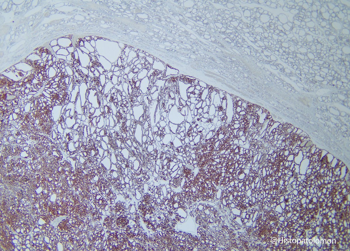 Histopatolomon's tweet photo. Brief SEAP pre-congress games.
This will be the last case in the series. I'll give the diagnosis to make it easier.
It's an oncocytic adenoma of the thyroid gland. Could you tell me what #IHCpath stain it is? #oncocytic #adenoma #thyroid #Endpath #SEAP2025SS @SEAP_IAP #pathology https://t.co/YhJzXYgUFL