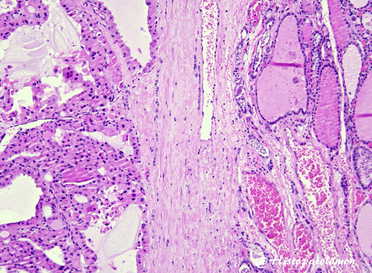 Histopatolomon's tweet photo. Brief SEAP pre-congress games.
This will be the last case in the series. I'll give the diagnosis to make it easier.
It's an oncocytic adenoma of the thyroid gland. Could you tell me what #IHCpath stain it is? #oncocytic #adenoma #thyroid #Endpath #SEAP2025SS @SEAP_IAP #pathology https://t.co/YhJzXYgUFL
