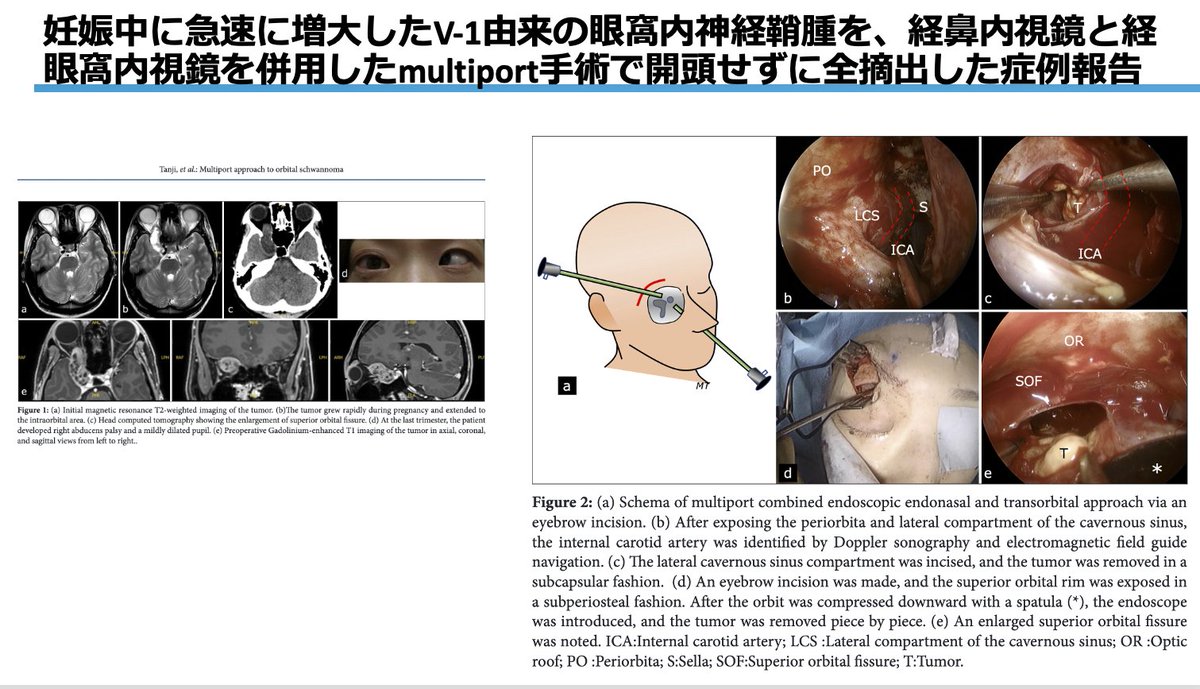 minaniyasashiku's tweet image. 妊娠中に急速に増大したV-1由来の眼窩神経鞘腫を、経鼻内視鏡と経眼窩内視鏡を併用したmultiport approachで開頭せずに全摘出した症例報告
#経鼻内視鏡　#経眼窩内視鏡　#multiport  2025-74

引用元はこちら
surgicalneurologyint.com/surgicalint-ar…