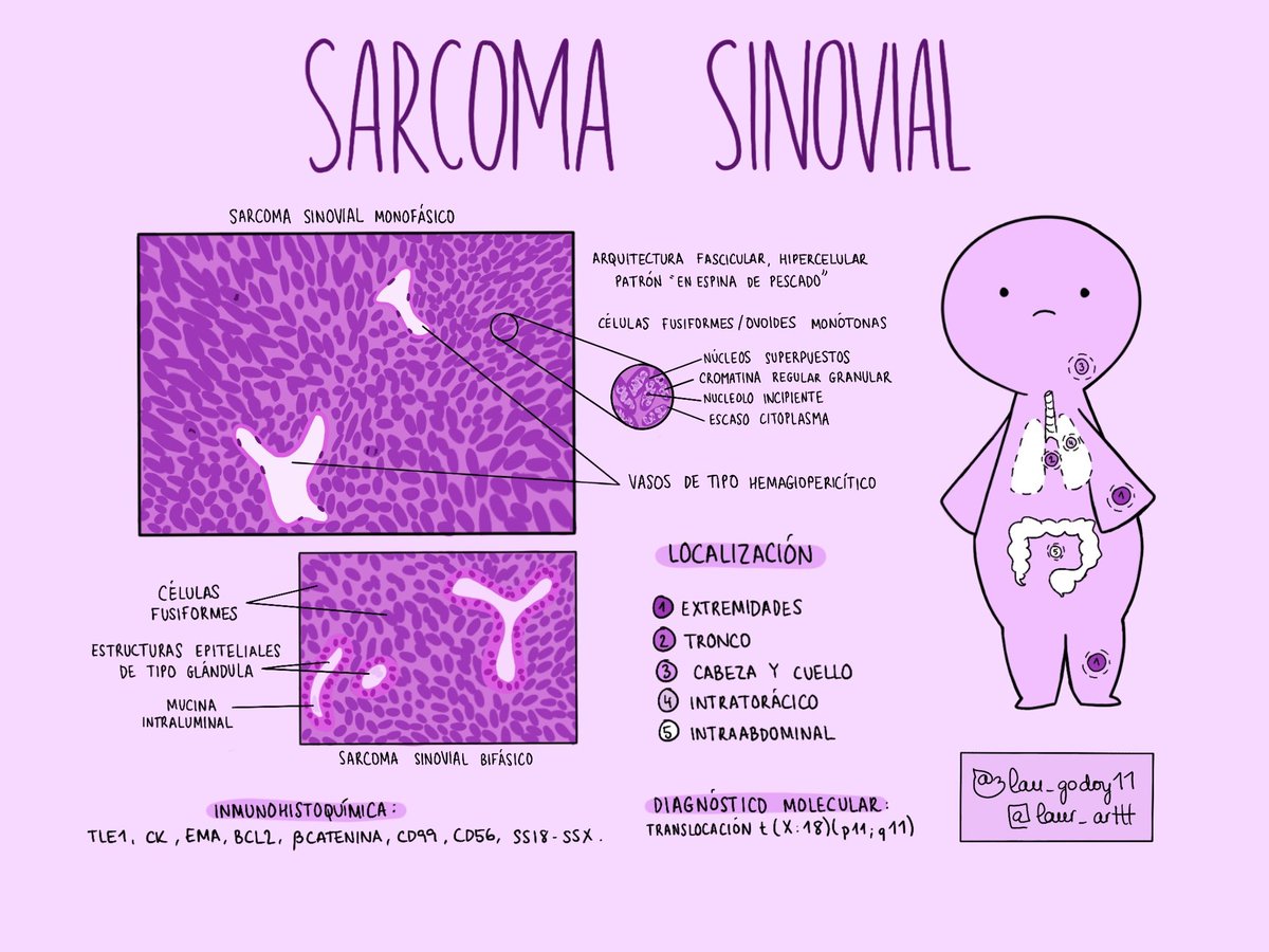 He vuelto a dibujar celulitas 💟
🔬Sarcoma sinovial / Synovial sarcoma🔬
#pathology #BSTpath #PathTwitter