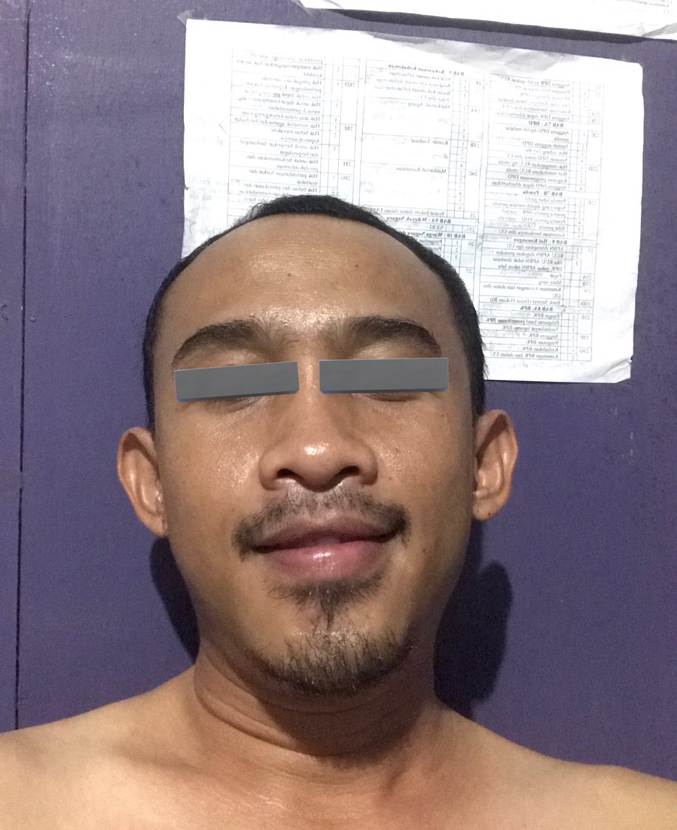 TLD_Survive's tweet photo. gilaaa dua combooo yang manteb betulll.
jadi bekas jerawat gue di hidung ada dua. dan ada jg bekas jerawat baru banget di pipi kanan.. setelah pemakaian #Hexylresorcinol #ForSkinSake dibarengi #Retinal langsung pudarrr gaesss gacorrr benerrrrr πππππππ₯°π₯°π₯° https://t.co/ASVj3AbnIY